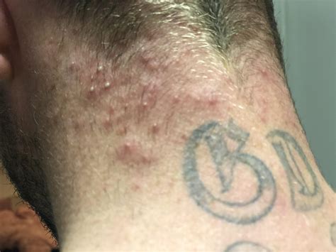 Acne My Husband Has Suffered Painful Acne On His Neck And Chest Since