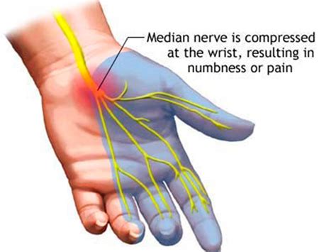 Carpal tunnel syndrome, the most common entrapment neuropathy of the upper extremity, is caused by compression of the median nerve as it travels through the carpal tunnel. Carpal Tunnel Syndrome: often seen, too often missed ...