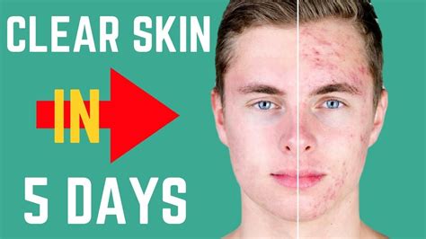 How To Really Get Clear Skin In 5 Days Youtube