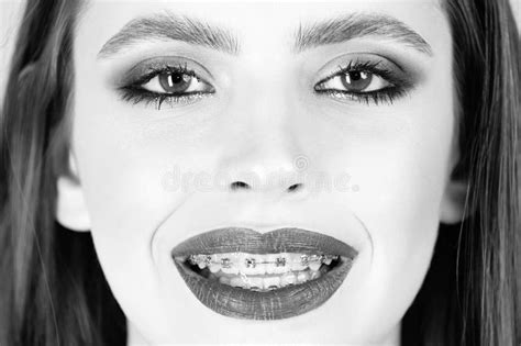 Teeth Braces Close Up Happy Young Woman With Braces On Teeth Portrait