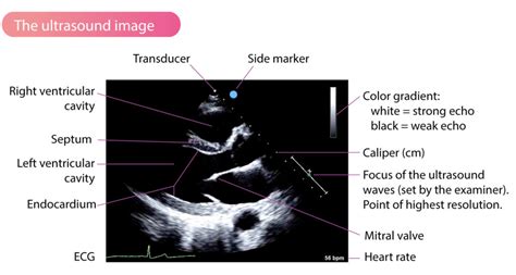 Two Dimensional 2d Echocardiography Ecg And Echo