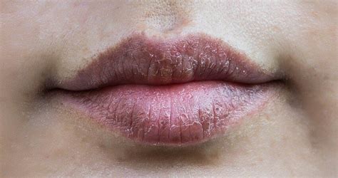 Dark Spots On Lips Remedy