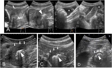 Frontiers Diagnostic Utility Of Ultrasonography For Duodenal Ulcers