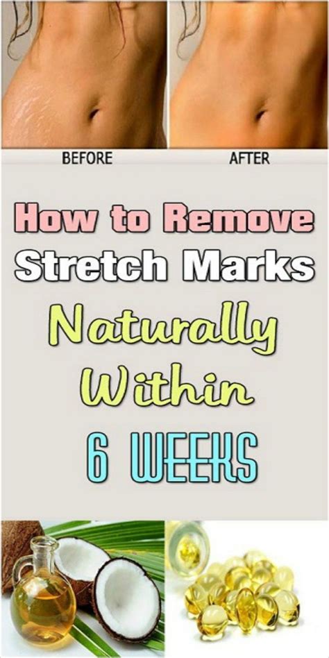 How To Remove Stretch Marks Naturally Within 6 Weeks Skiny Health