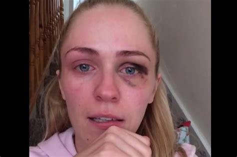 Woman Shares Emotional Video On Domestic Violence After Partner Leaves Her With Black Eye