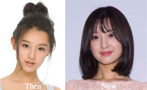 Kim Yoo Jung Plastic Surgery