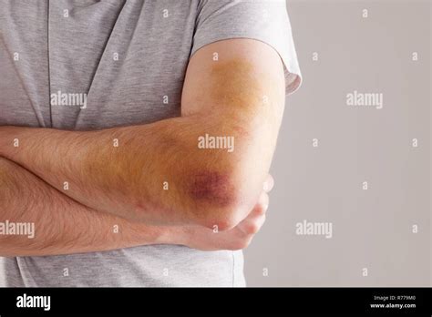 Hematoma Arm High Resolution Stock Photography And Images Alamy