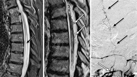 Spinal Vascular Malformations The Neurosurgical Atlas