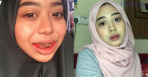 Ketika mencabut gigi akan menimbulkan ada nya nyeri. Penat DIEJEK, Gadis Ini Nekad Pakai Braces Melalui DOKTOR ...