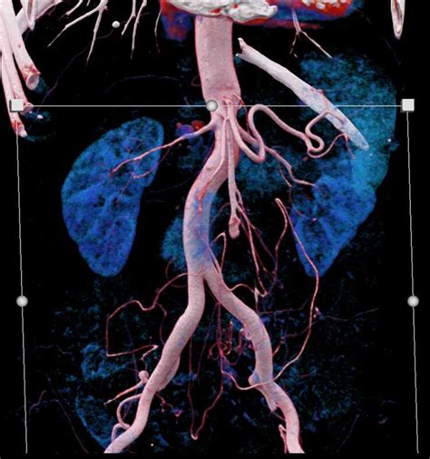 Superior Mesenteric Artery Sma Aneurysm Vascular Case Studies