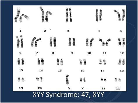 47xyy Syndrome Genetics Home Reference