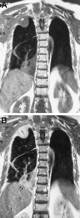 Ct manifestations in 50 cases. A 61-year-old patient with malignant pleural mesothelioma ...