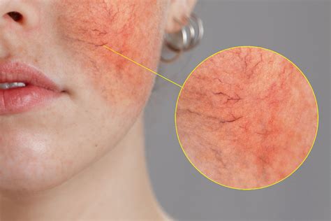 All About Rosacea And Acne Rosacea — Aes Acne Clinic San Francisco