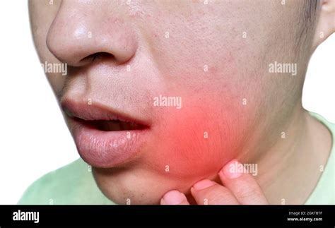 Inflammation Of Lymph Node Hi Res Stock Photography And Images Alamy