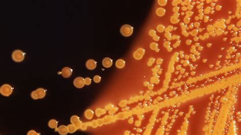 Researchers Find Second Us Patient Infected With Superbug Gene