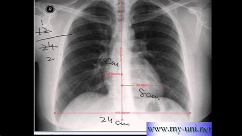 Cardiomegaly Chest Xray