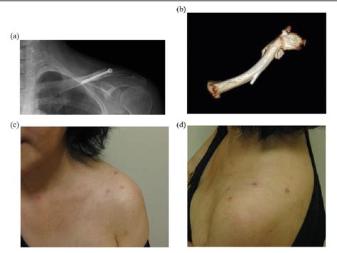 Figure 1 From Arthroscopic Fixation Of The Clavicle Shaft Fracture