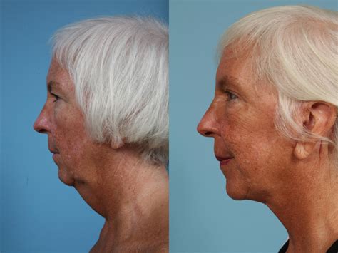Neck Lift Before And After Photos Patient 88 Chicago Il Tlkm Plastic