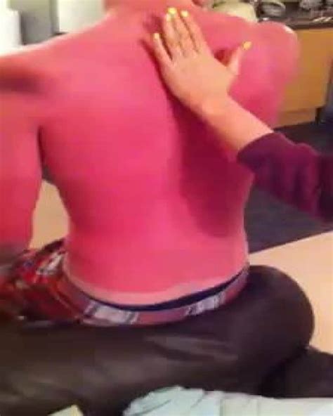 The Worst Sunburns In History