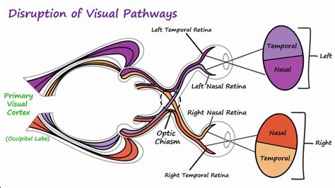 Visual Neural Pathways And Visual Field Defects Youtube