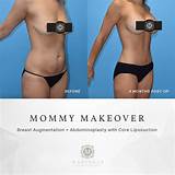 Images of Plastic Surgery Mommy Package