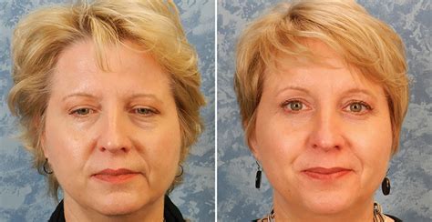 Endoscopic Brow Lift Forehead Lift Surgery Plastic Surgeon Dallas