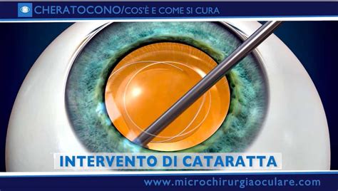 Cura Del Cheratocono Ultime Novit