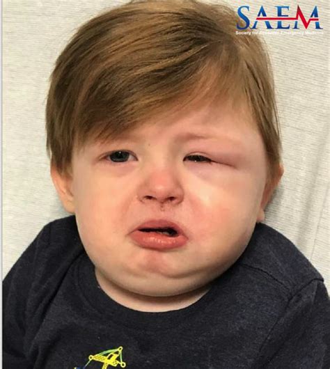 Saem Clinical Image Series Facial Swelling In A 2 Year Old Med Tac