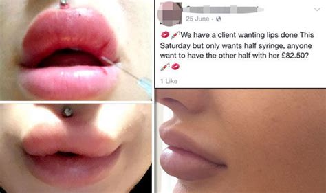 Revealed Lip Filler Frenzy Leaving Teenage Girls With Horrific Damage