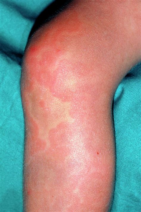 Allergic Urticaria On Leg Photograph By Dr P Marazziscience Photo Library
