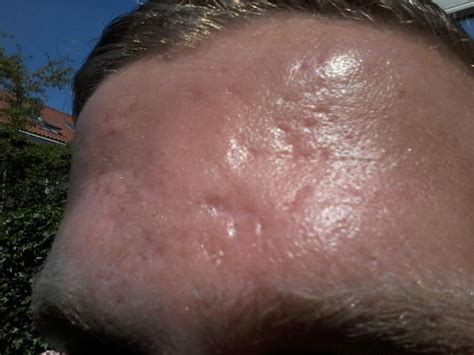 Forehead Scars Help Me Identify Treat Them Scar Treatments Acne