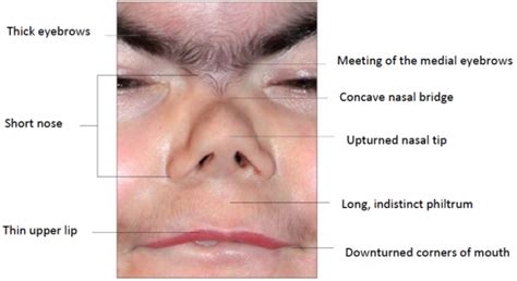 What Are The Physical Characteristics Of Cornelia De Lange Syndrome Cdls Foundation Uk And Ireland