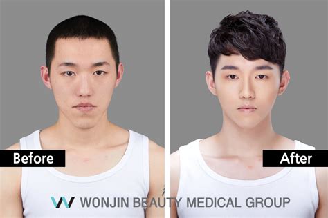 Korean Male Before And After Plastic Surgery