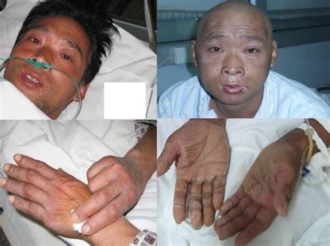 Hisashi Ouchi The Most Radiated Man In The World Morbid Kuriosity