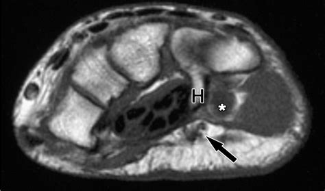 Peripheral Neuropathies Of The Median Radial And Ulnar Nerves Mr