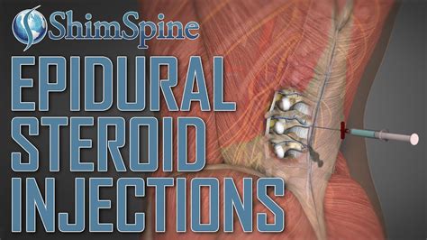 Epidural Steroid Injections Do They Work Shimspine