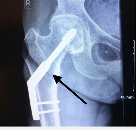Dynamic Hip Screw With A Two Hole Plate For The Neck Of The Femur
