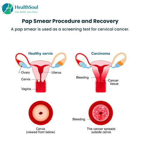 Pap Smear Procedure And Recovery Obstetrics Gynecology Healthsoul