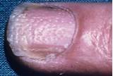 Photos of Fingernail Eczema Treatment