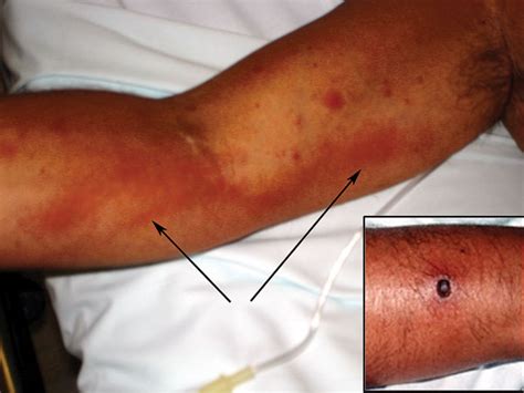 Figure Lymphangitis In A Portuguese Patient Infected With Rickettsia