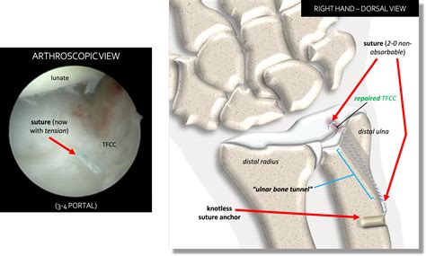 Arthroscopic Tfcc Ulnar Bone Tunnel Foveal Repair In Adult Patients