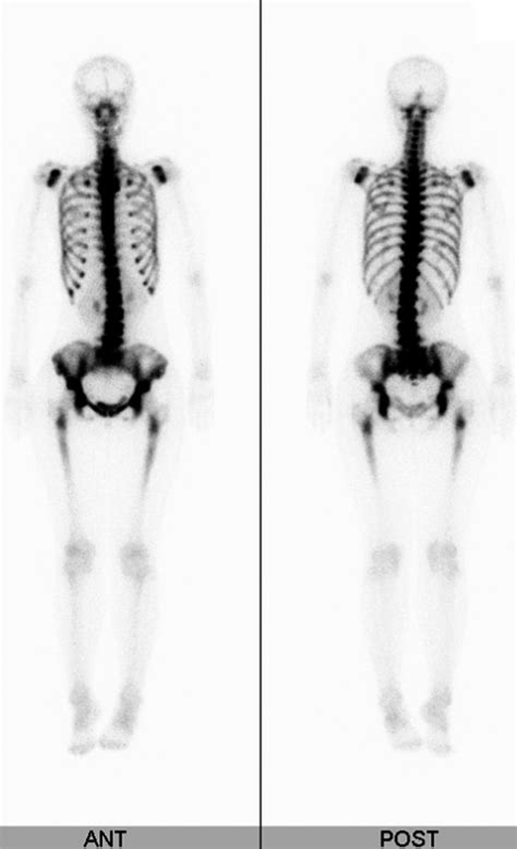 Bone Scintigraphy Bone Scintigraphy Shows Diffuse Even And Dense