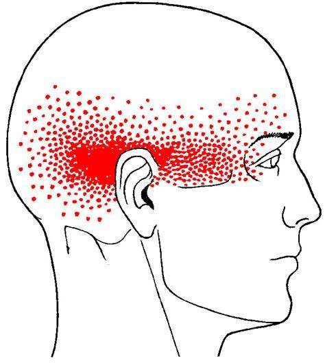 Sub Occipital Trigger Point Pain Referral Pattern Symptoms And Prevention
