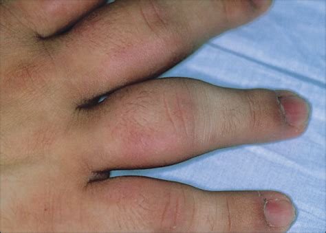 Acquired Fusiform Swelling Of The Fingers—quiz Case Critical Care