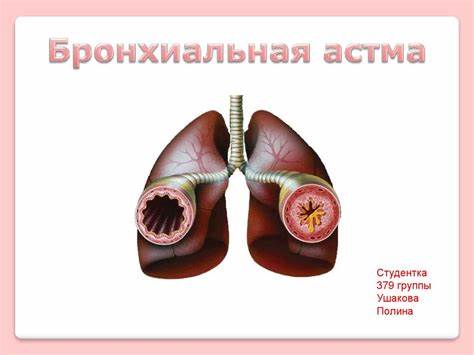 Бронхиальная астма диеты Бронхиальная астма - презентация онлайн Бронхиальная астма - презентация онлайн Бронхиальная астма диеты