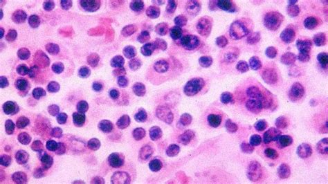 Along with high fever, it can cause abdominal pains headache, and loss of appetite. LAPD employee contracts bacteria that causes typhoid fever ...