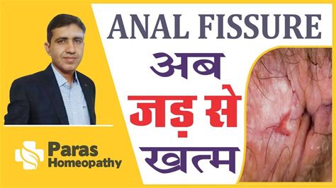 Anal Fissure Fissure Treatment In Homeopathy Anal Fissure Treatment