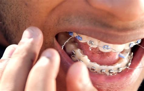 Most problems can be temporarily solved by yourself, at home, until your next scheduled appointment. Dental Emergencies ~ Clinica Dentista, Pasig Dentist ...