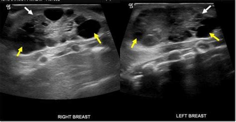Ultrasound Of Neonatal Breast Enlargement Eurorad