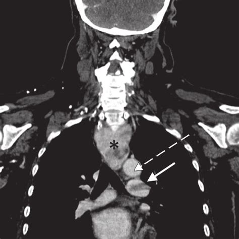 Pdf Large Substernal Thyroid Goiter Associated With Saddle Pulmonary